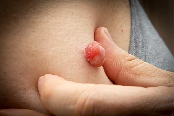 skin tag removal